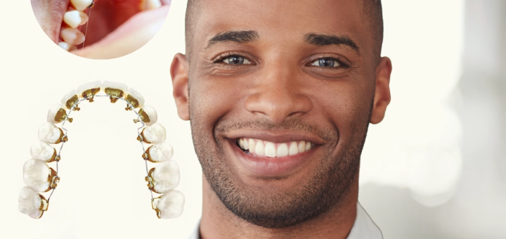 Why Discreet Ceramic Braces Are Winning Over Adult Patients